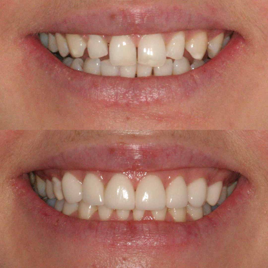 Forever Dental and Skin before and after photos of dental veneers